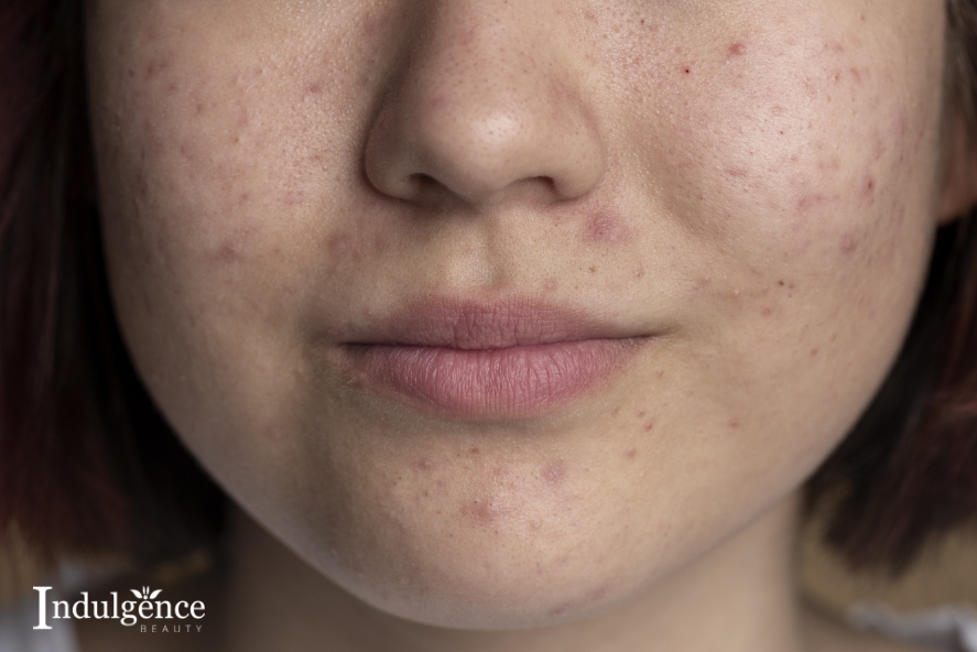 5 Alternatives To Lasers For Fading Acne Scars