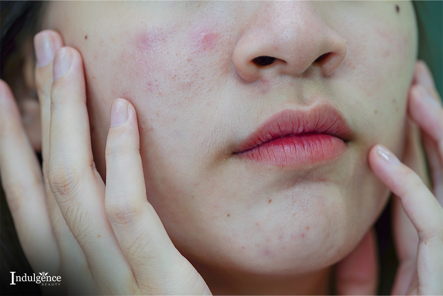 Best Ingredients For Fading Stubborn Acne Scars To Look Out For In Skincare