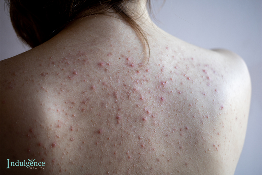 Preventing back acne scars effectively